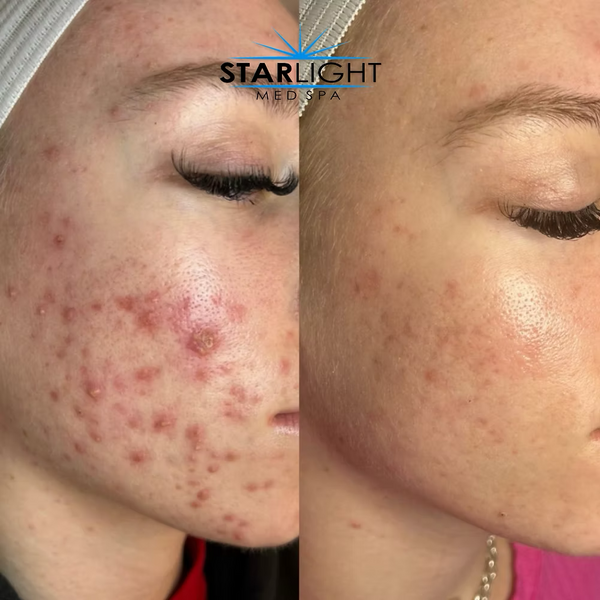 CLEARING COMPLEX Acne Serum