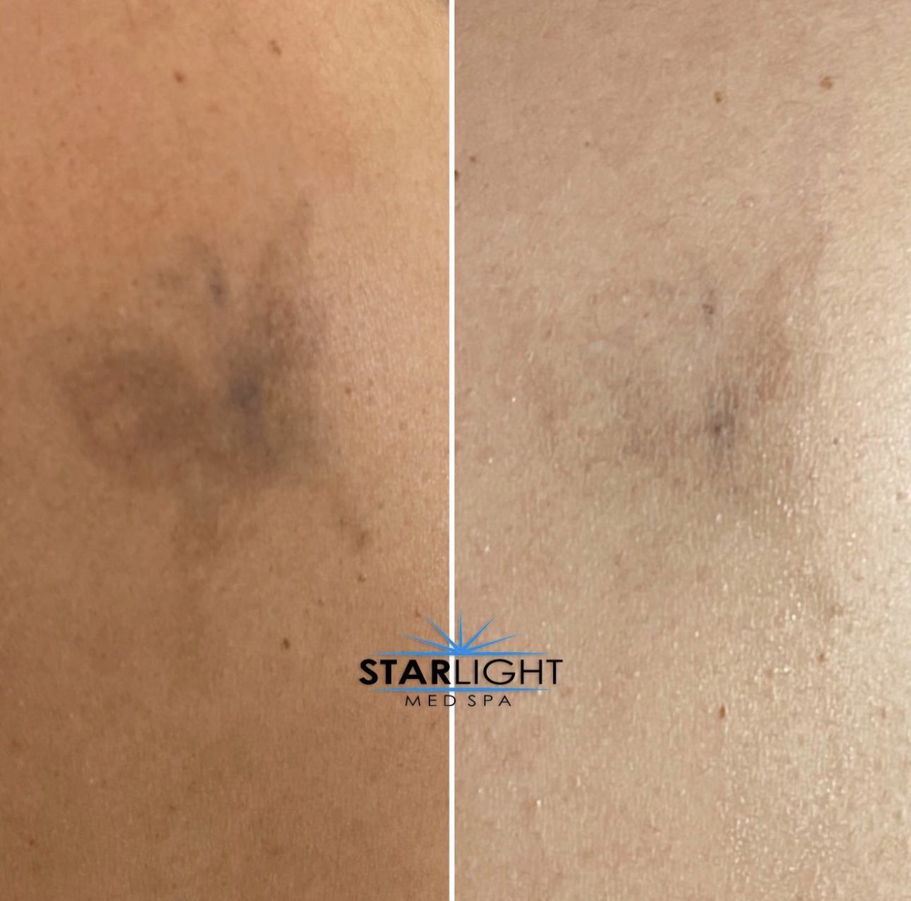 Before and after Starlight Skin laser treatment