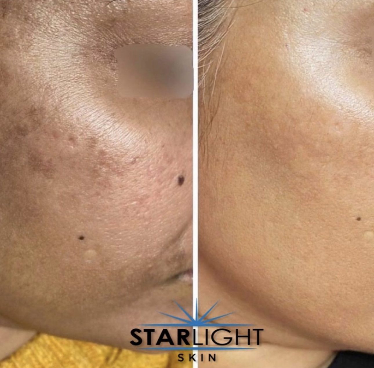 Before and after Starlight Skin treatment — smoother texture and softened scarring
