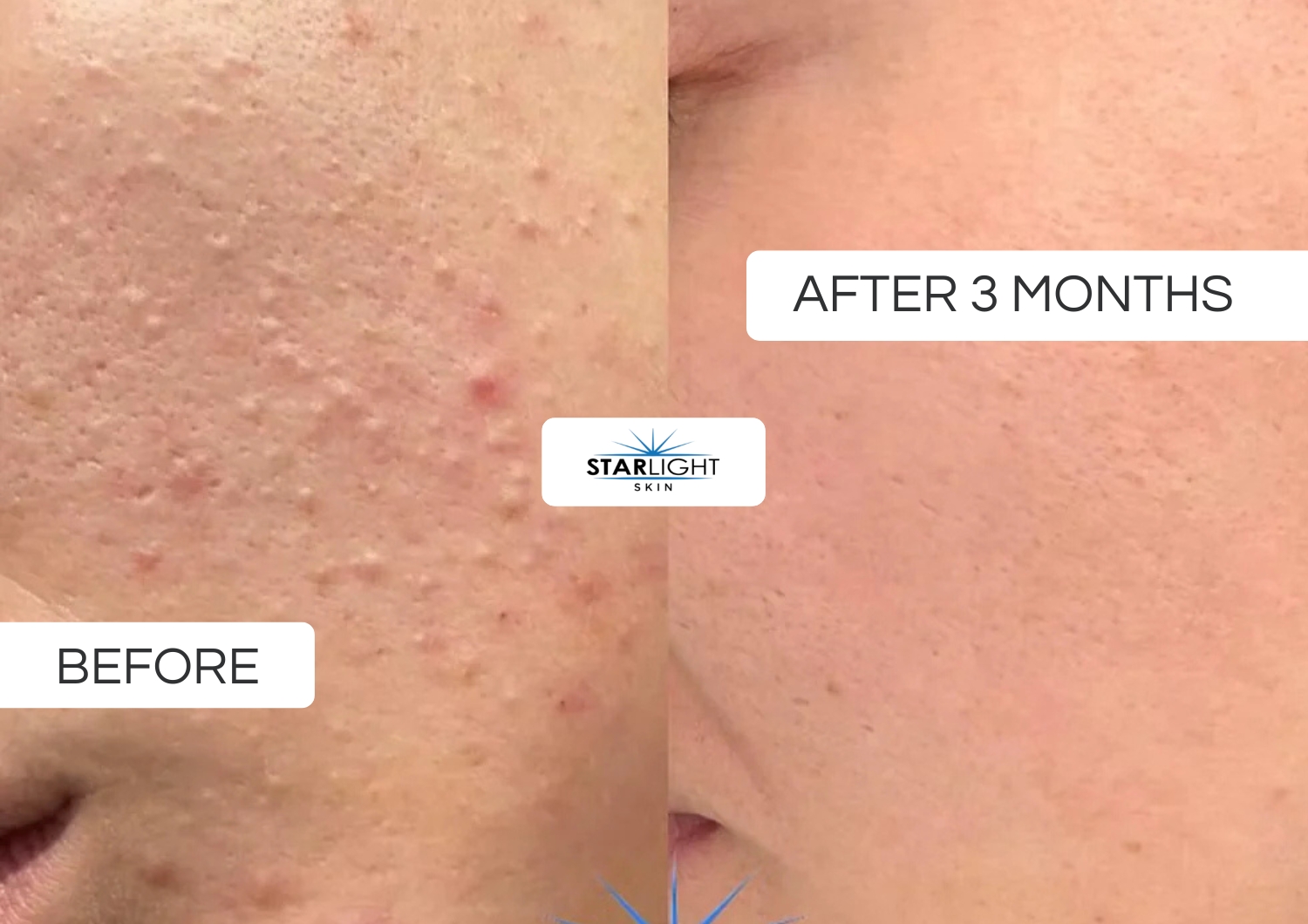 Before and after three months of Starlight Skin, texture and pores