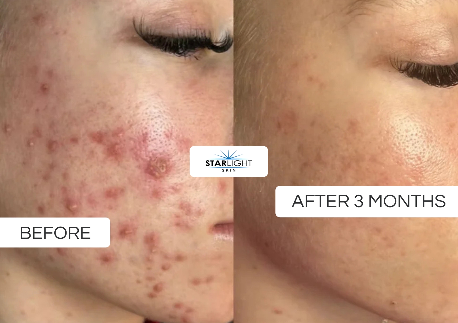 Before and after three months of Starlight Skin, cystic acne and scarring