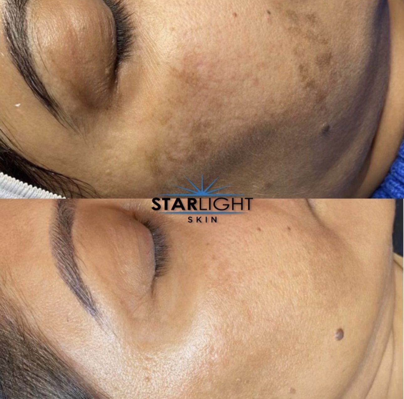 Before and after Starlight Skin treatment — brighter, more even tone