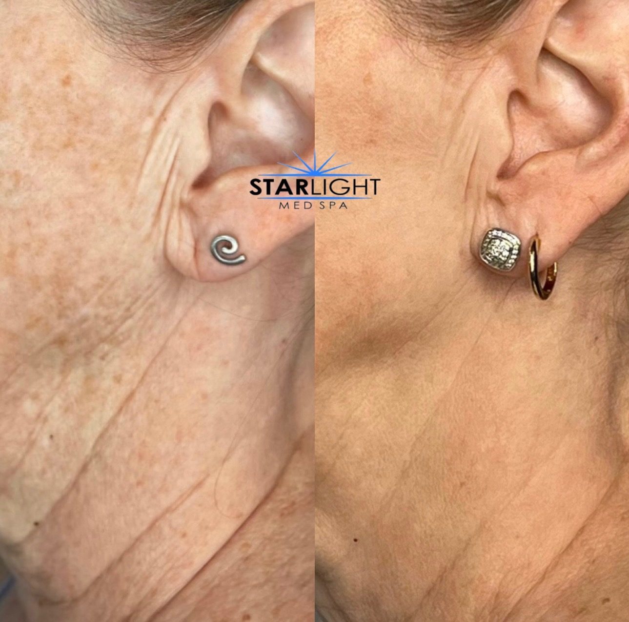 Before and after Starlight Skin treatment — firmer, lifted skin