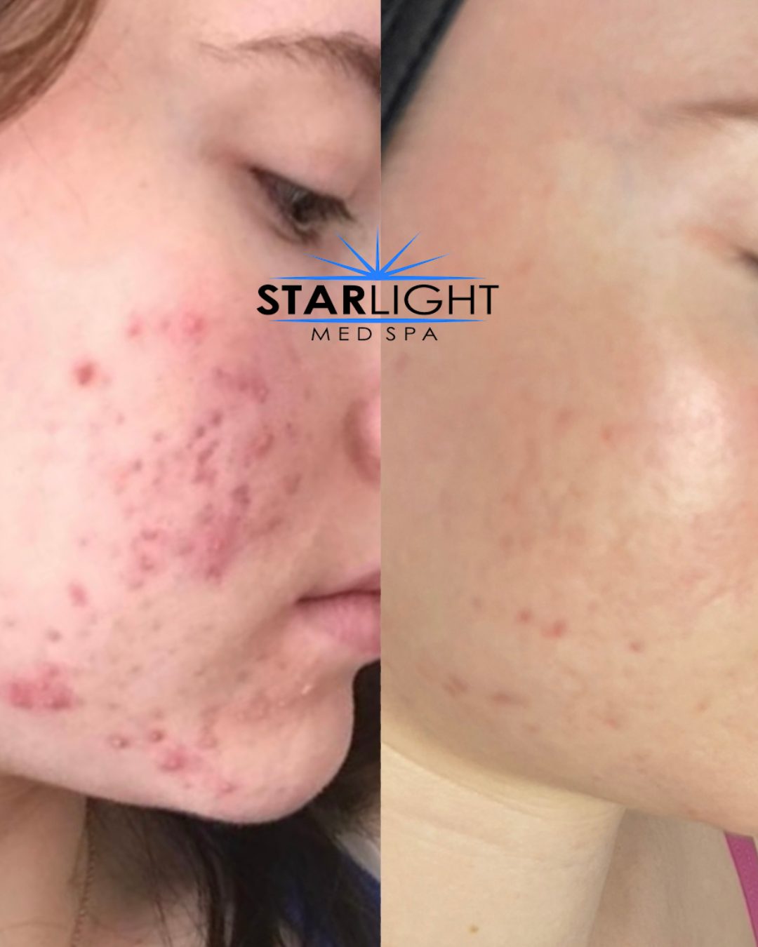 Before and after Starlight Skin treatment — clearer skin, calmer breakouts