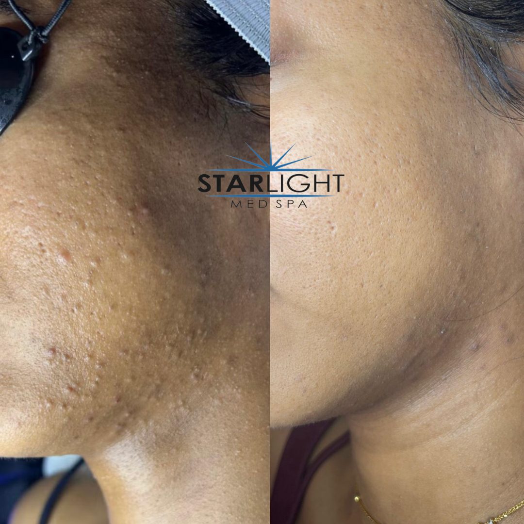 Before and after Starlight Skin treatment — brighter, more even tone