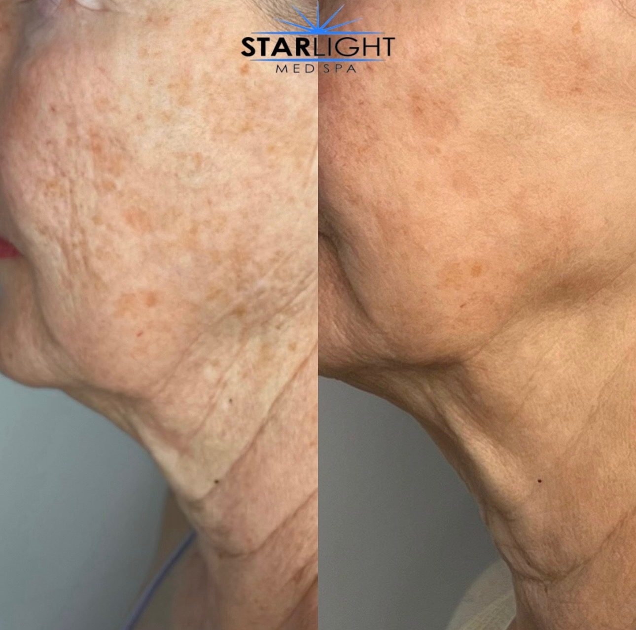 Before and after Starlight Skin treatment — firmer, lifted skin