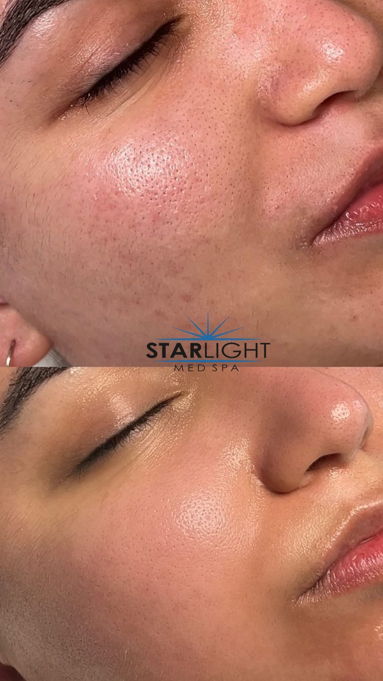 Before and after Starlight Skin treatment — clearer skin, calmer breakouts