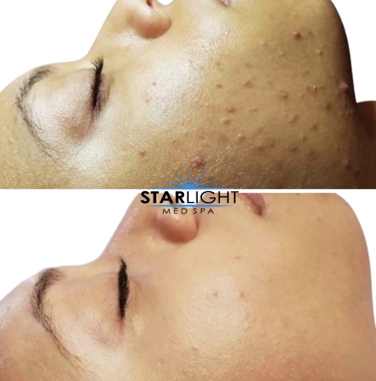 Before and after Starlight Skin treatment — clearer skin, calmer breakouts