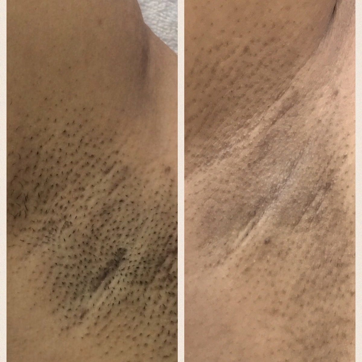 Before and after Starlight Skin laser treatment