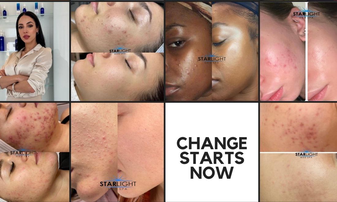 The Comedogenic Scale Explained: What it really means for your skin?