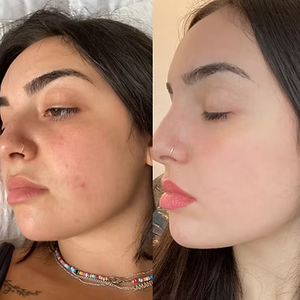 INTENSE PULSED LIGHT Therapy