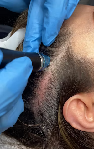 Hydrafacial ™ Keravive Scalp Rejuvenation