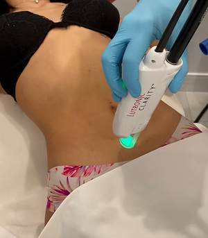 Laser Hair Removal - Small Areas