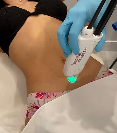 Laser Hair Removal - Small Areas