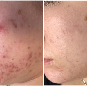 MICRONEEDLING