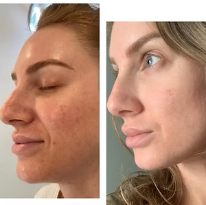 ALEX/YAG PHOTOREJUVENATION