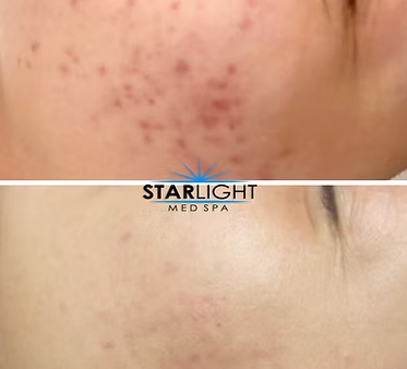 CHEMICAL PEEL