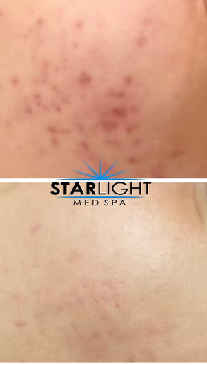 Perfect Derma Peel