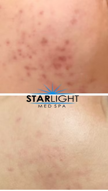 Perfect Derma Peel