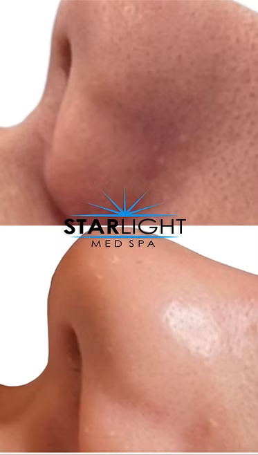 PLATINUM HYDRAFACIAL PERK®