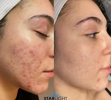 CHEMICAL PEEL