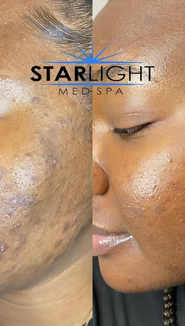 Perfect Derma Peel