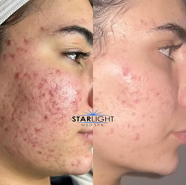 ALEX/YAG PHOTOREJUVENATION