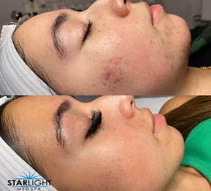 CHEMICAL PEEL