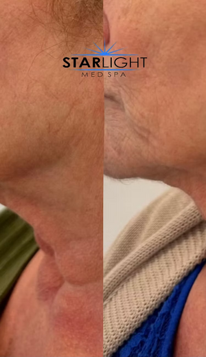 FORMA - Face or Neck