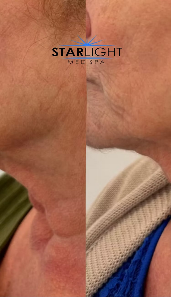 FORMA - Face or Neck