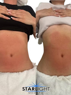 Starlight Body Contouring - 15 Mins.