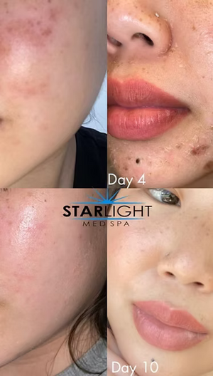 Perfect Derma Peel