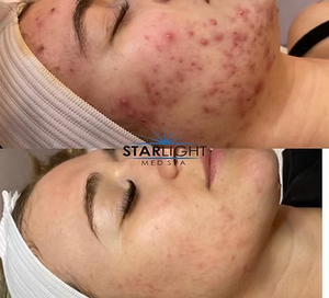CHEMICAL PEEL