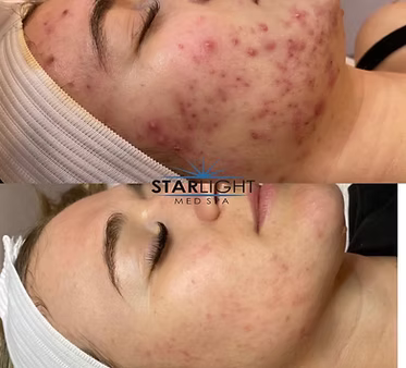 CHEMICAL PEEL
