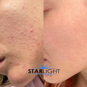 CLEARING COMPLEX Acne Serum