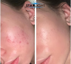 CHEMICAL PEEL