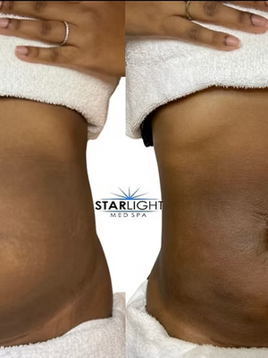 Starlight Body Contouring - 15 Mins.