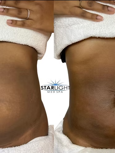 Starlight Body Contouring - 15 Mins.