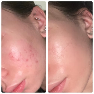 CLEARING COMPLEX Acne Serum