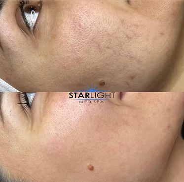 ALEX/YAG PHOTOREJUVENATION
