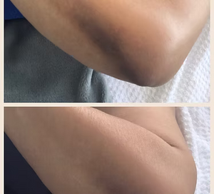 CHEMICAL PEEL