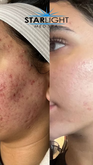 Perfect Derma Peel