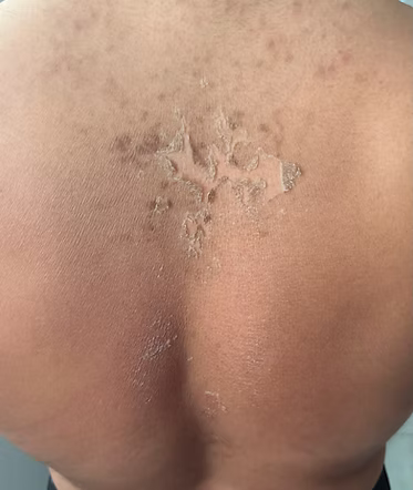 Green Peel (Body)