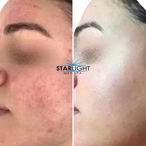 INTENSE PULSED LIGHT Therapy
