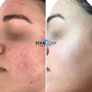 INTENSE PULSED LIGHT Therapy
