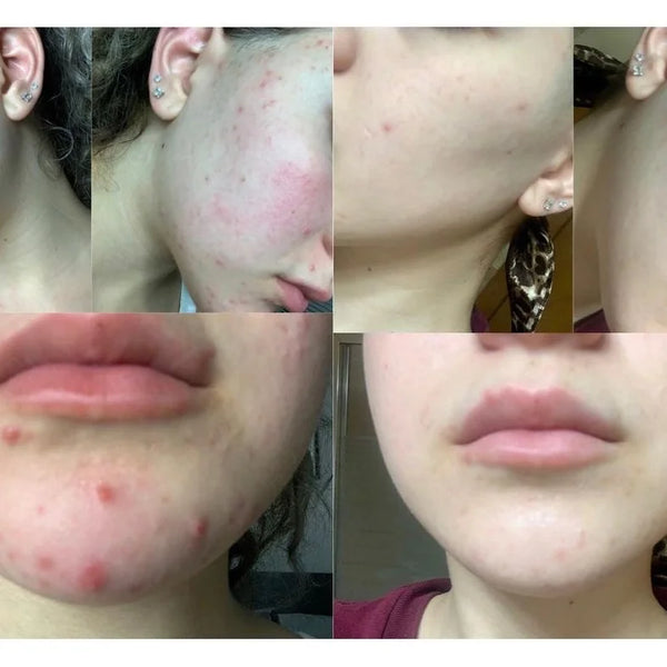 CLEARING CLEANSER Acne Wash