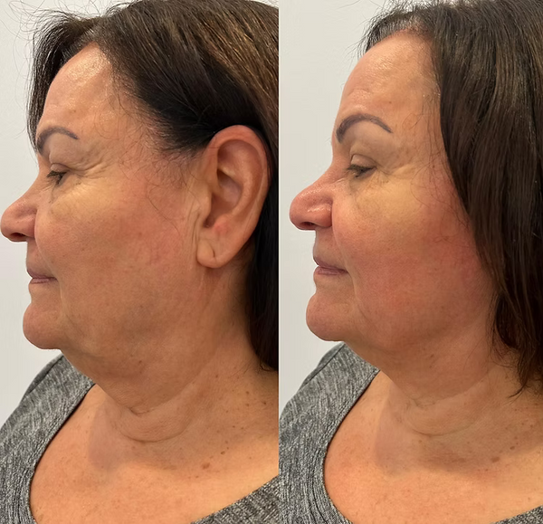 FORMA - Face + Neck