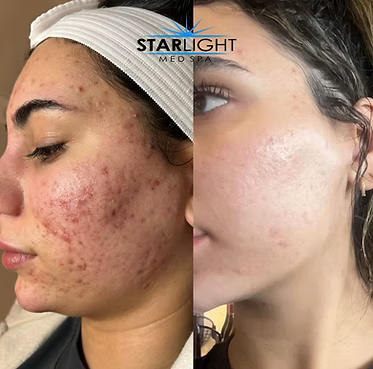 MICRONEEDLING