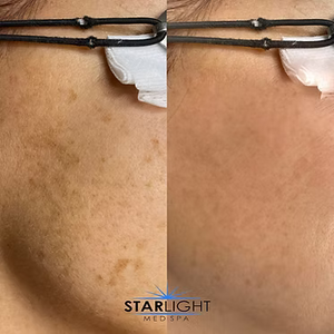 INTENSE PULSED LIGHT Therapy