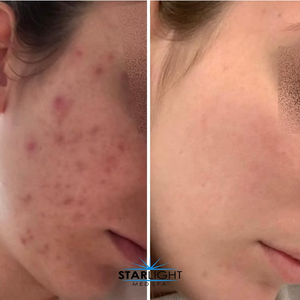 CLEARING COMPLEX Acne Serum